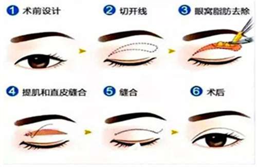 林登文割双眼皮怎么样？医生实力曝光
