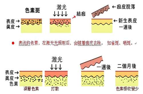 点阵激光一到七天图公布,看科普与案例反馈