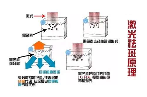 调q激光祛斑的危害与效果怎么样?收集了相关信息