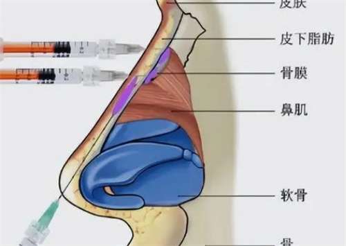 海南瑞韩医学美容医院地址?隆鼻案例分享