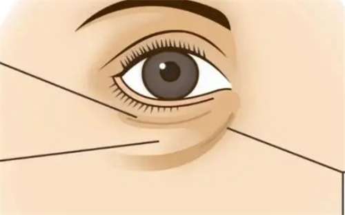 去除黑眼圈眼袋有效方法？去除黑眼圈眼袋后多久恢复？