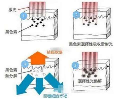 皮秒激光机器多少钱一台?能去黑色素沉着吗?