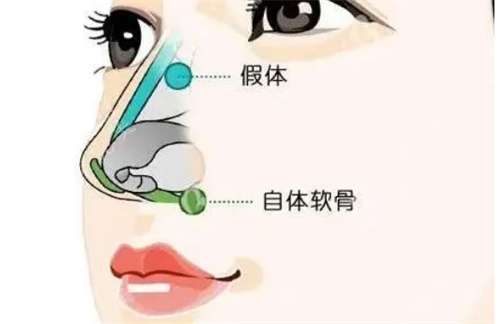 上海天佑医院医疗美容科做鼻子怎么样?价目收费