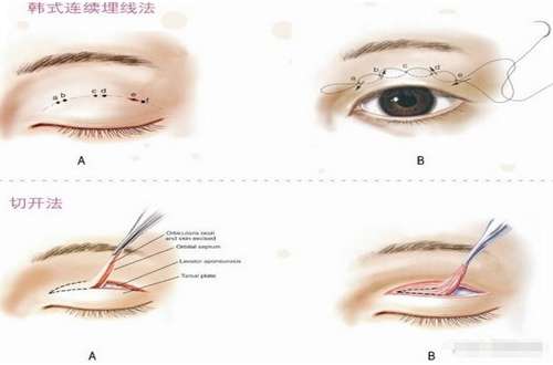 男生双眼皮手术要多少钱？探讨风险、恢复阶段