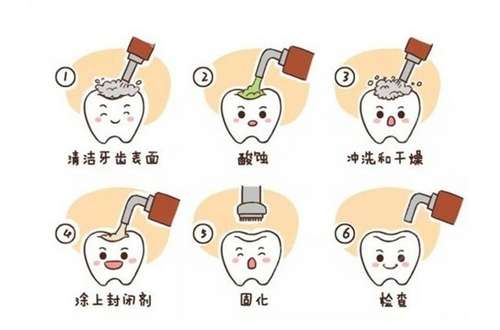 补牙过程需要几次?补牙前需要做什么准备?
