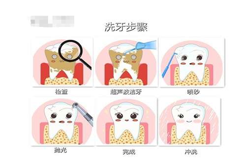 超声波洁牙疼吗?解说注意事项+更加科普详情