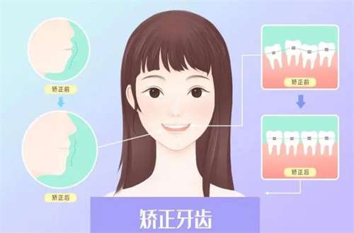 矫正牙齿需要多少钱?具体收费详细已经告知
