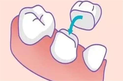 烤瓷假牙可以做ct吗?关心的问答这里回答了