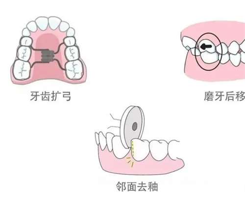 美容冠矫正牙齿的危害有哪些?科普知识在线了解