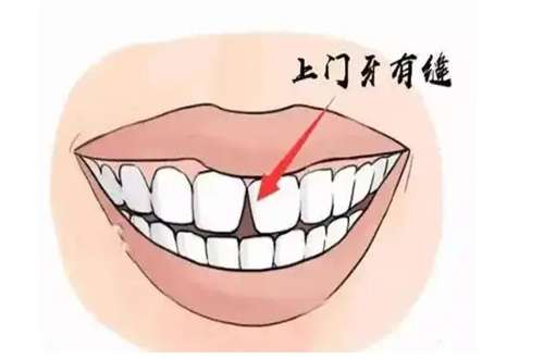 门牙有缝1.jpg