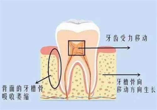 戴牙套会改变脸型吗?戴牙套可以改良嘴凸吗?