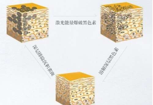 dpl精准光祛斑是什么原理?会伤害皮肤吗?