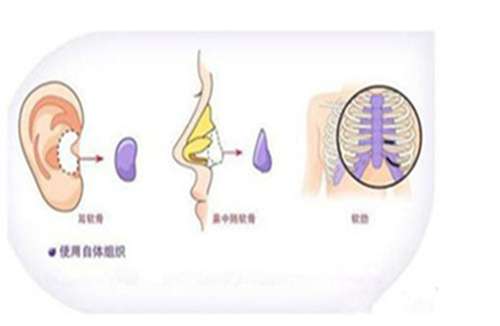 姬付康做的鼻子怎么样？医生信息在线了解