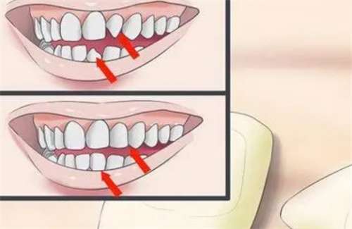 纳米烤瓷牙的优缺点?纳米烤瓷牙后牙齿坚固吗?