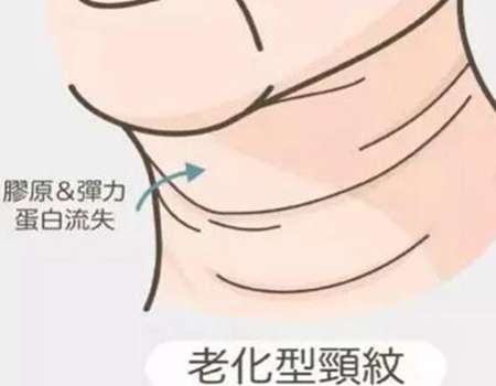 嗨体去颈纹利弊一览，嗨体去除颈纹多久打一次?