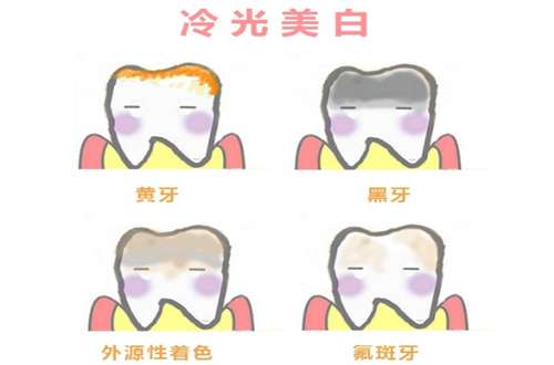 冷光美白牙齿多少钱?相关注意问题已经整理