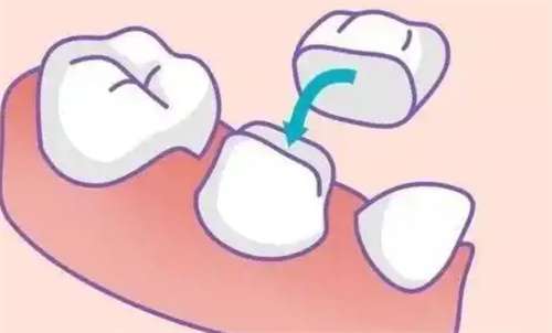门牙烤瓷牙多少钱?使用寿命是几年?