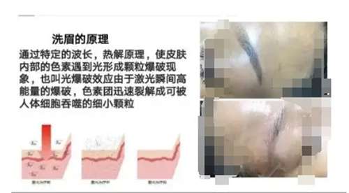 激光洗眉一般需要多少钱?激光洗眉毛几天可以恢复好?