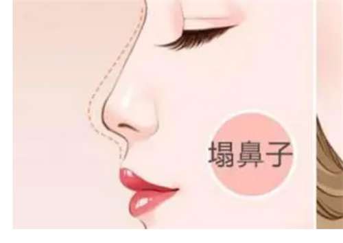 鼻子整容术需要多少钱?术后护理注意事项