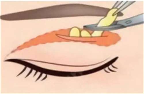 男生双眼皮手术多久能恢复自然?男生双眼皮术后多久恢复?