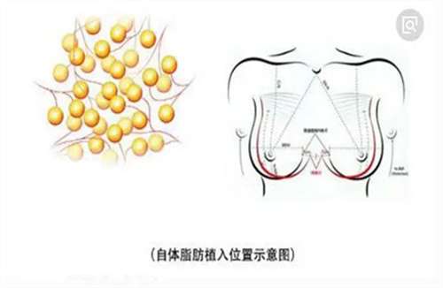 自体脂肪丰胸可以维持多长时间？自体脂肪丰胸可以捏吗？