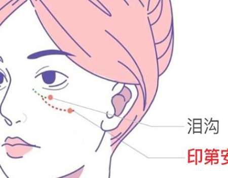 脂肪填充泪沟鼓包怎么解决?脂肪填充泪沟费用是多少?