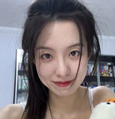 驼峰鼻整形前后对比怎么样?驼峰鼻型填充查看