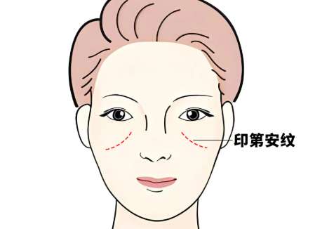 印第安纹做什么医美项目？了解科普信息简介