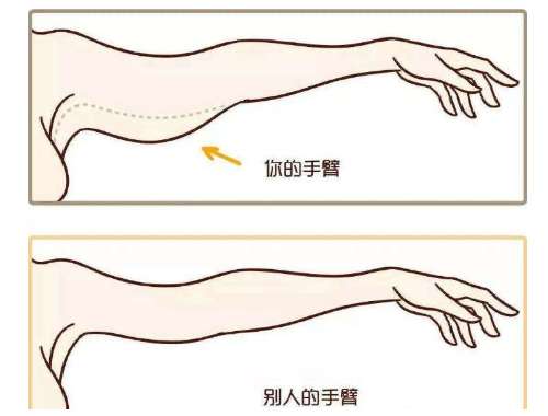 蝴蝶袖吸脂对比图展示!告别蝴蝶袖一招就够了!