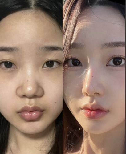 缩小鼻翼多少钱？为你讲透价格那些事儿