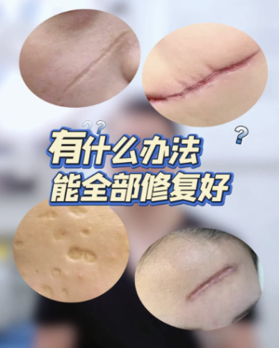 兰州疤痕修复哪家医院好点?