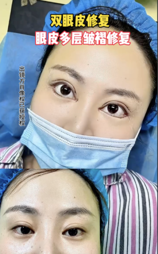 长沙双眼皮修复哪家医院好?今天好好盘一盘