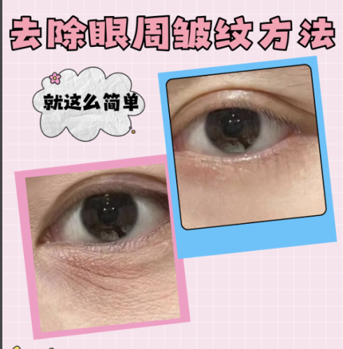 怎么去眼部皱纹?实用妙招全攻略