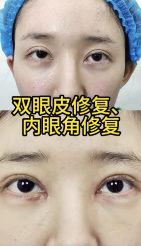 上海张诗若修复双眼皮内眼角怎么样?眼部修复实力派大揭秘