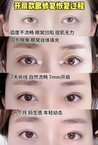 长沙双眼皮修复医生推荐:拯救 “翻车” 双眼的宝藏医师