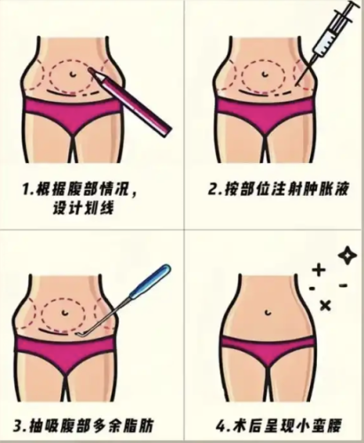 武汉腰腹环吸做的好的医生,以下三位可得牢牢记住