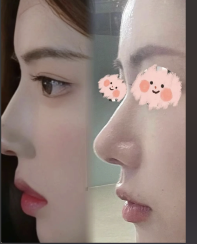 硅胶假体隆鼻好不好