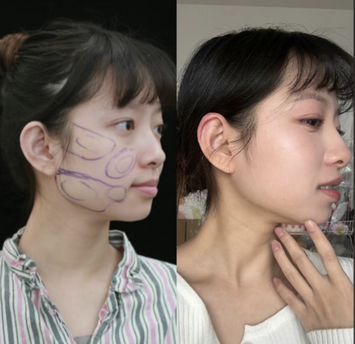 马梅生面部吸脂多少钱啊?来看真实收费标准