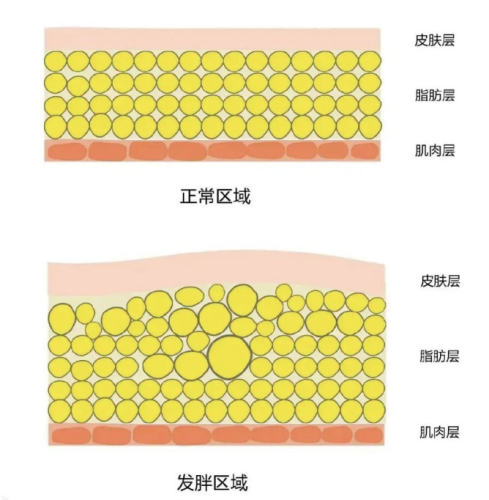 产前吸脂好还是产后吸脂好?怎么选才明智?