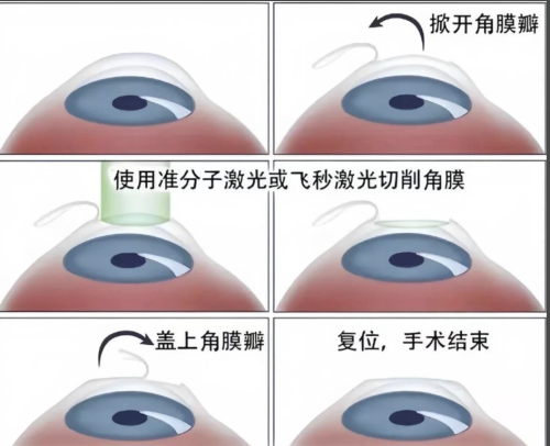 深圳哪里可以做近视眼手术?摘镜指南送给你