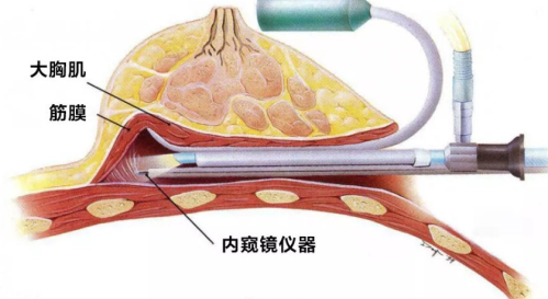 南京假体隆胸哪家好?内窥镜隆胸好医院私藏