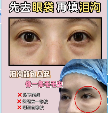 重庆做祛眼袋泪沟填充哪家好?给眼周 “填坑” 的高手都在这