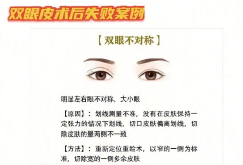 长沙双眼皮修复专家排名,专治各种双眼皮翻车现场