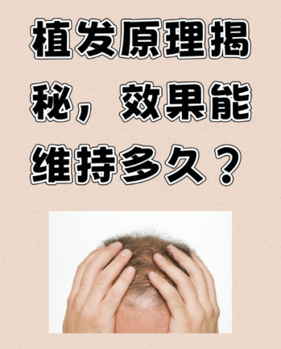 头发种植原理:给秃发区 “移栽” 健康毛囊