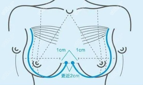 上海哪个医院做胸部整形不知道选?看完这篇就有数!