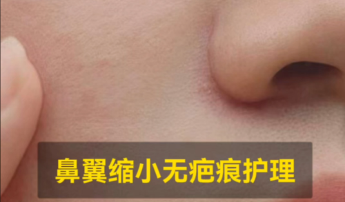 鼻翼缩小内切口多久愈合?术后恢复进程与注意事项详解