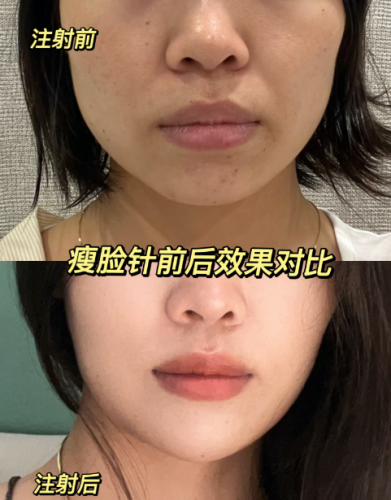 苏州哪家整形医院打瘦脸针好？效果测评直接抄作业！