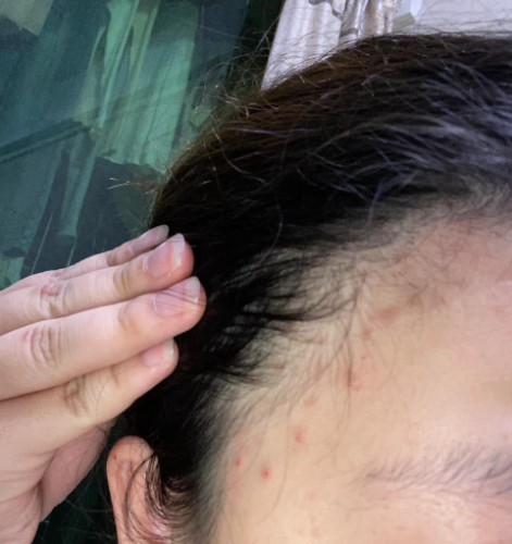 发际线附近长痘痘是啥原因?常见诱因与应对方法