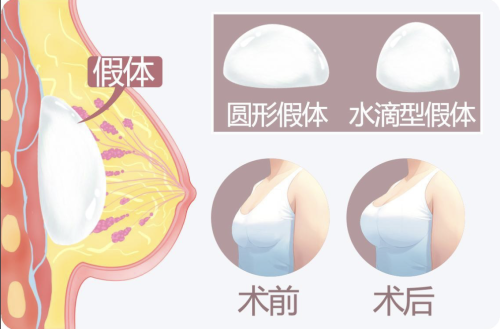 南京假体隆胸排行榜:必看 TOP 榜!速码!