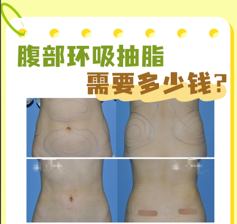 武汉腰腹环吸多少钱?价格图谱与机构甄选指南都在这